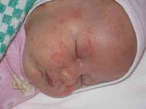 Причины и лечение потницы у новорожденного