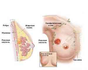 Рак молочной железы, рак молочной железы у мужчин