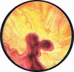 Цистоскопический атлас - Псевдополипоз мочевого пузыря